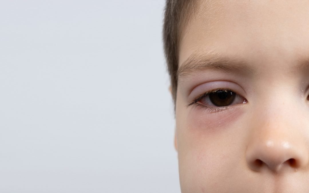How Long Does Pink Eye Typically Last in Children?
