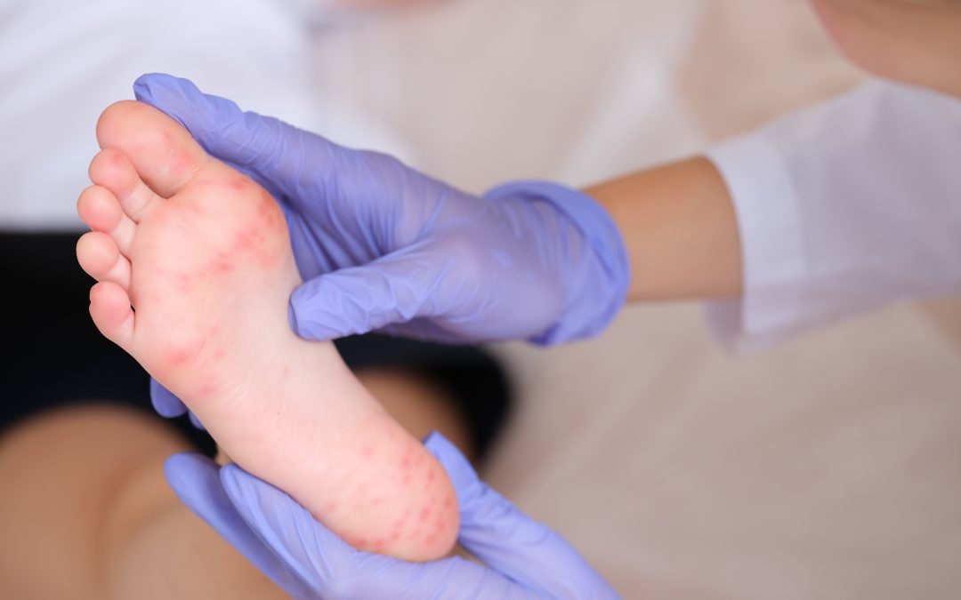 Does Hand, Foot, and Mouth Disease Last Long?
